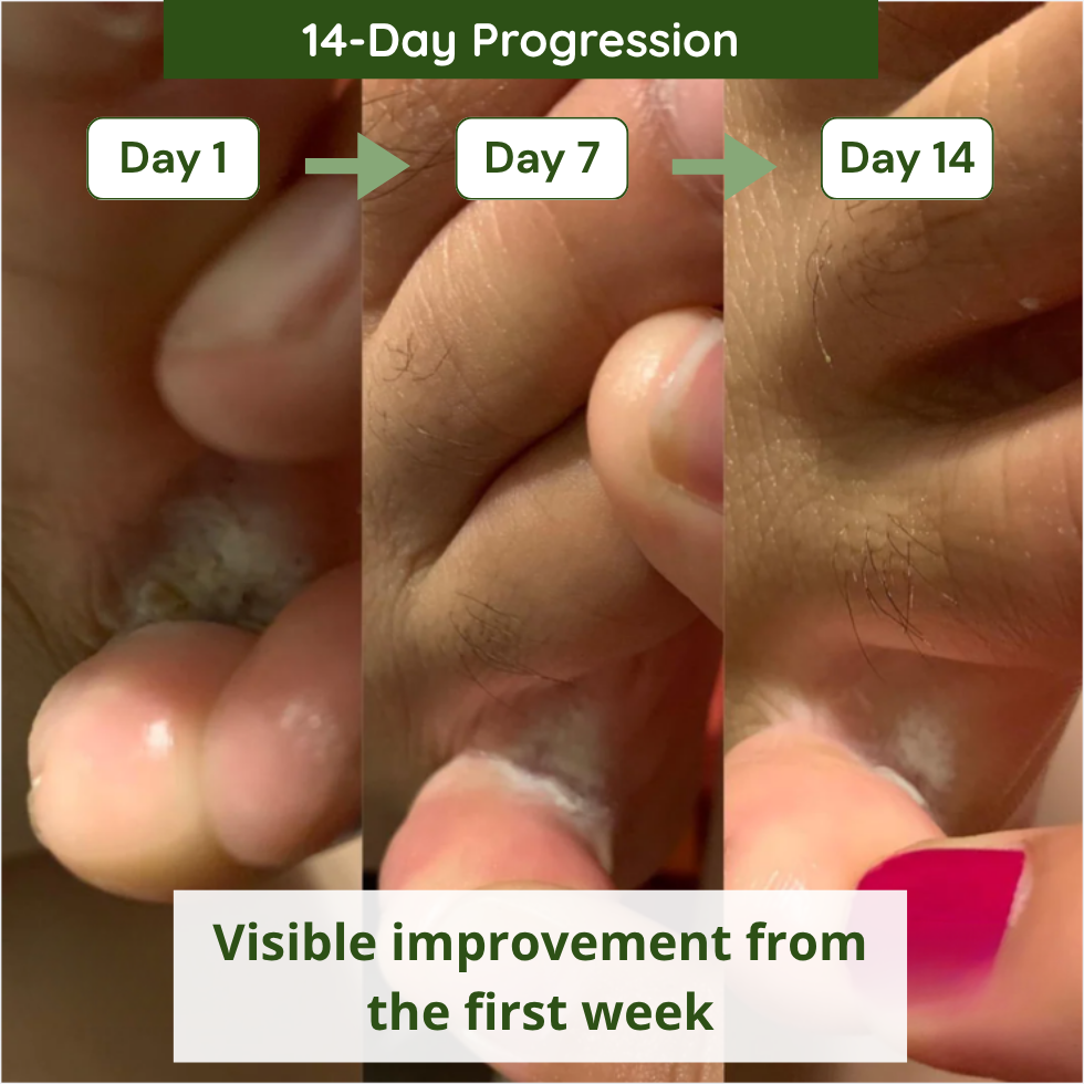 Verdalyae Anti-Fungal Soap 14-day progression