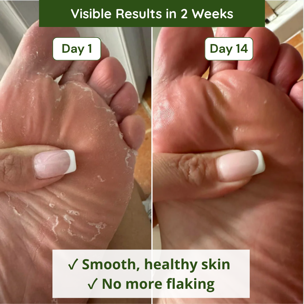 Verdalyae Anti-Fungal Soap 2-week results